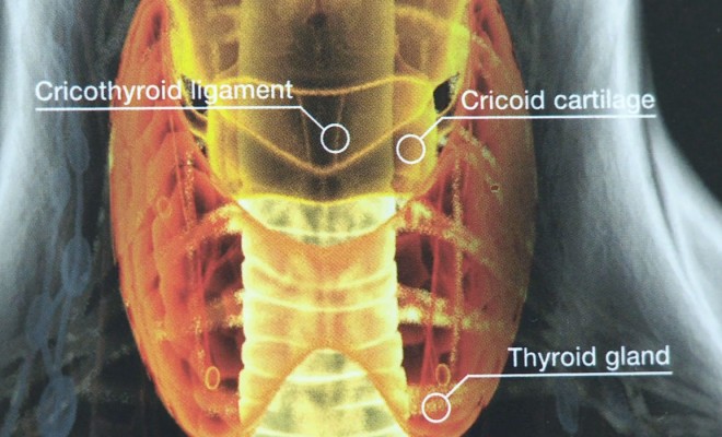 Graves’ disease