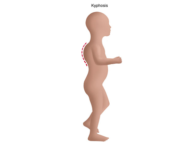 Kyphosis