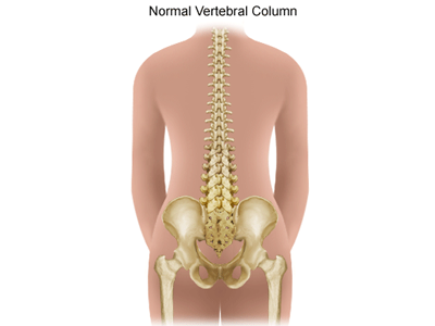 Scoliosis