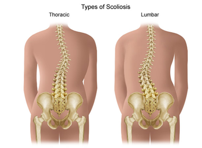 Scoliosis