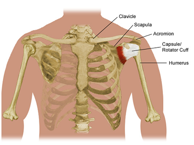 Shoulder Tendonitis